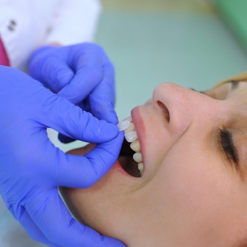 Cosmetic dentist placing a veneer on a patients front tooth