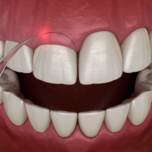 Illustrated dental laser treating a gummy smile