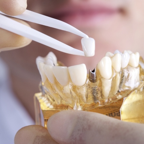 Dentist placing a dental crown onto a model of a dental implant