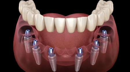Illustrated full denture being placed onto six dental implants