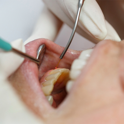 Close up of dental patient receiving treatment with dental laser