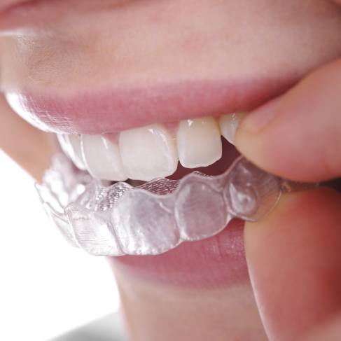 Close up of person placing an Invisalign tray over their teeth